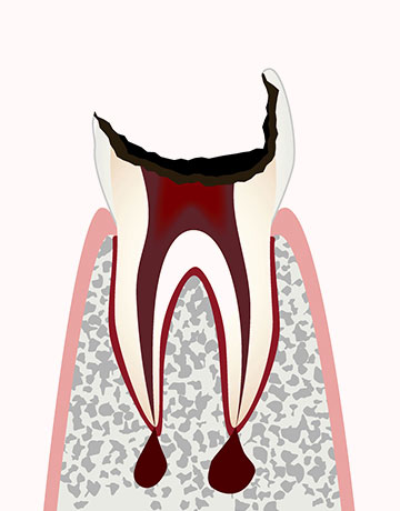 C4（シーフォー）： 歯の大部分を失う