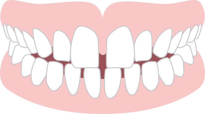 空隙歯列