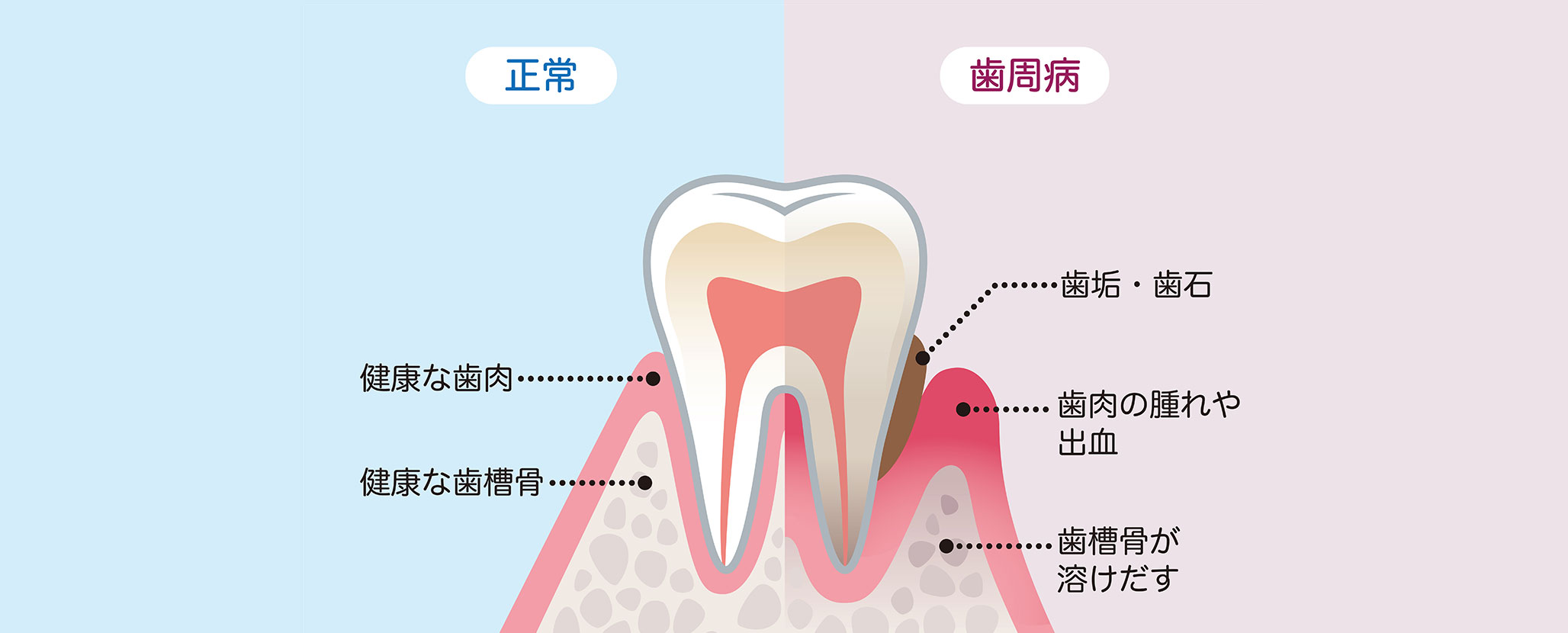 歯周病とは